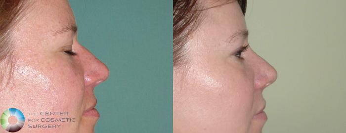 Before & After Rhinoplasty Case 607 View #3 View in Golden, CO