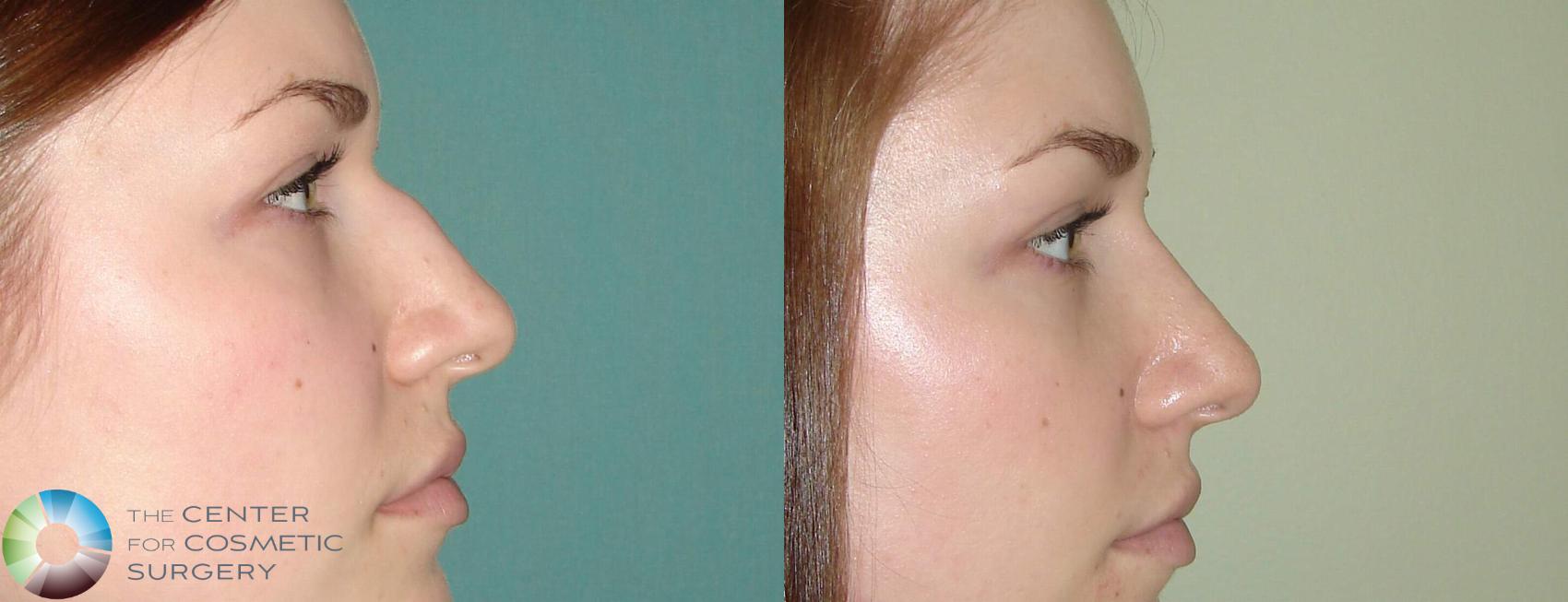 Before & After Rhinoplasty Case 644 View #1 in Denver and Colorado Springs, CO