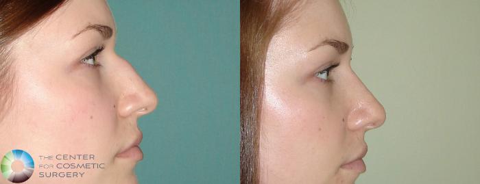 Before & After Rhinoplasty Case 644 View #1 View in Golden, CO