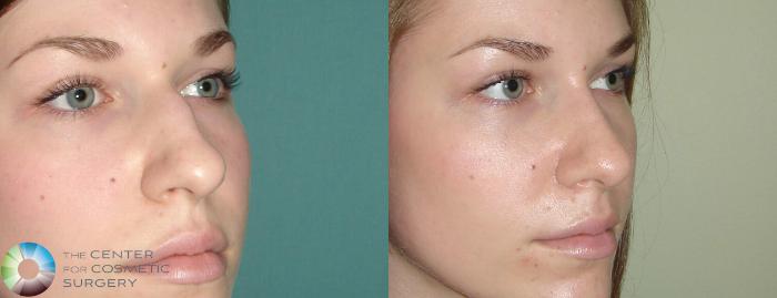Before & After Rhinoplasty Case 644 View #2 View in Golden, CO