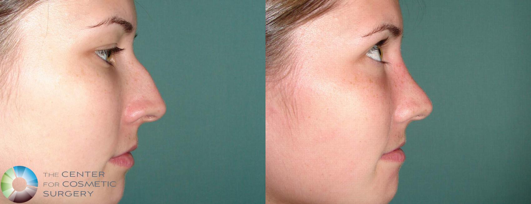 Before & After Rhinoplasty Case 655 View #1 View in Golden, CO
