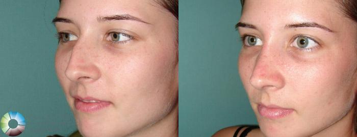 Before & After Rhinoplasty Case 655 View #2 View in Golden, CO