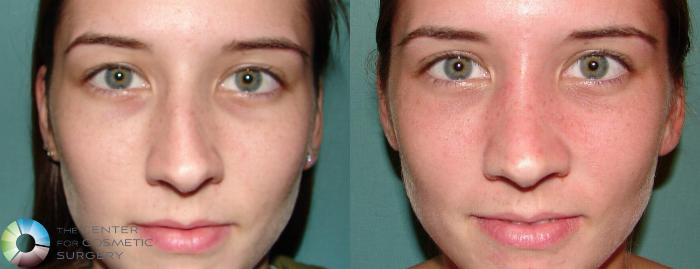 Before & After Rhinoplasty Case 655 View #3 View in Golden, CO