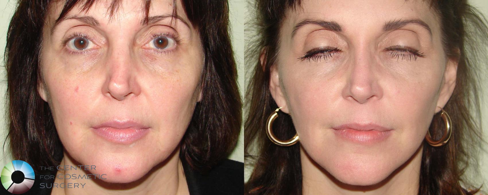 Before & After Rhinoplasty Case 669 View #1 in Denver and Colorado Springs, CO