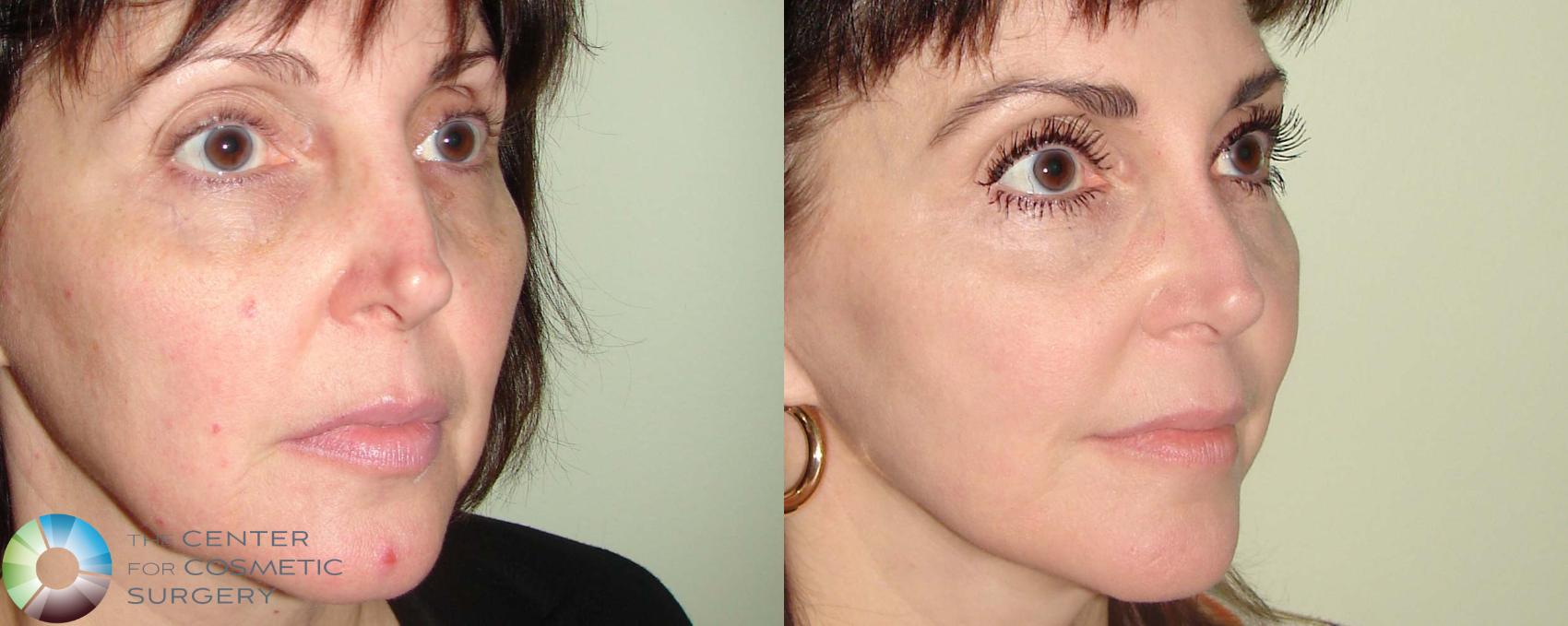 Before & After Rhinoplasty Case 669 View #2 View in Golden, CO