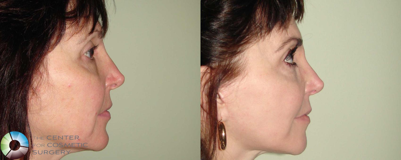 Before & After Rhinoplasty Case 669 View #3 View in Golden, CO