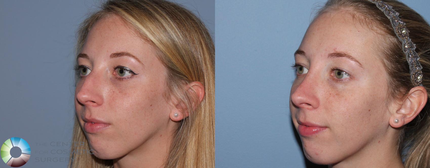 Before & After Rhinoplasty Case 788 View #2 View in Denver & Golden, CO