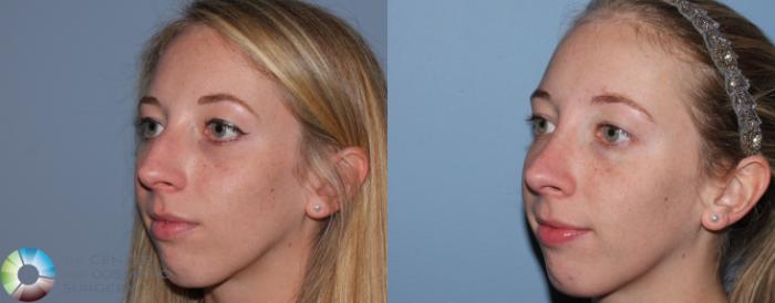 Before & After Rhinoplasty Case 788 View #2 View in Golden, CO
