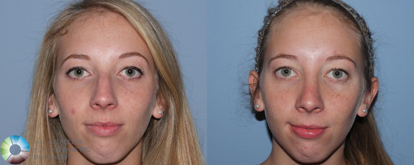 Before & After Rhinoplasty Case 788 View #3 View in Golden, CO