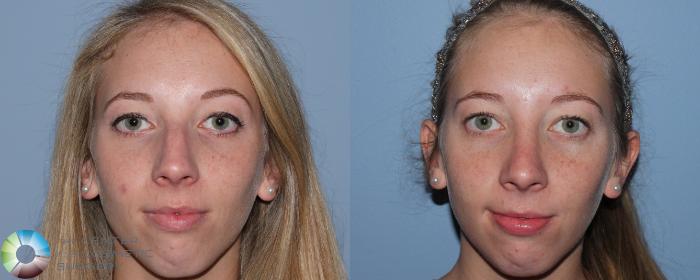Before & After Rhinoplasty Case 788 View #3 View in Golden, CO