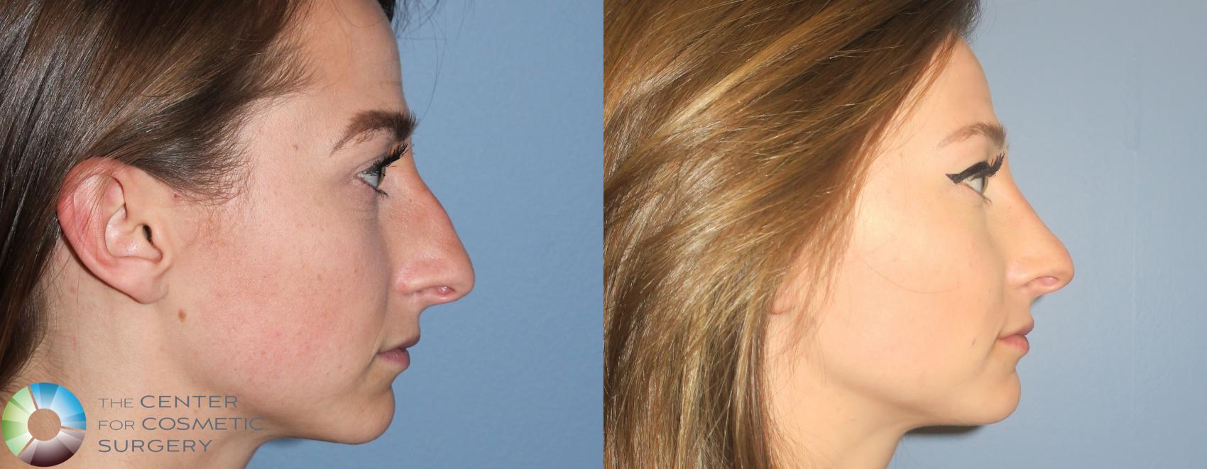 Before & After Rhinoplasty Case 789 View #1 in Denver and Colorado Springs, CO