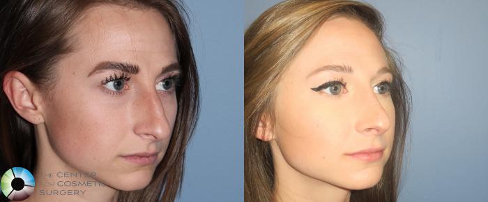 Before & After Rhinoplasty Case 789 View #2 View in Golden, CO