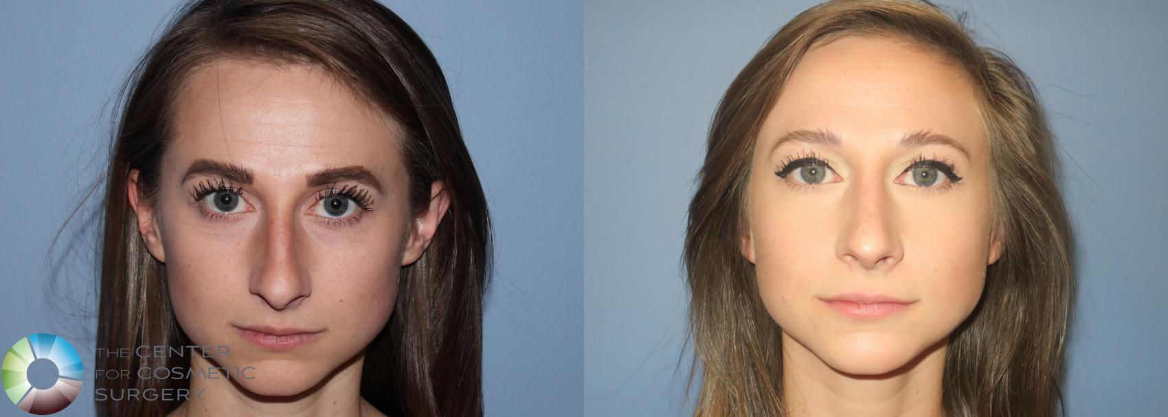 Before & After Rhinoplasty Case 789 View #3 View in Golden, CO