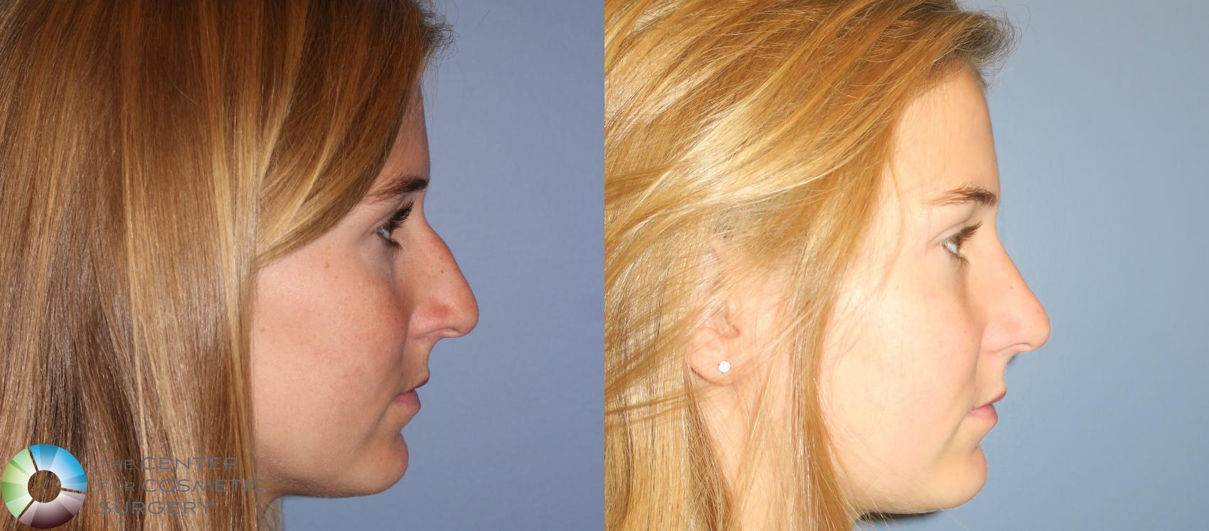 Before & After Rhinoplasty Case 790 View #1 in Denver, CO