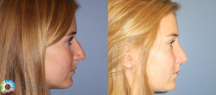 Before & After Rhinoplasty Case 790 View #1 View in Golden, CO