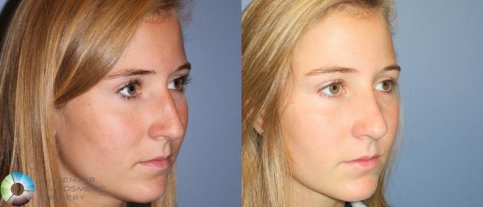 Before & After Rhinoplasty Case 790 View #2 View in Golden, CO