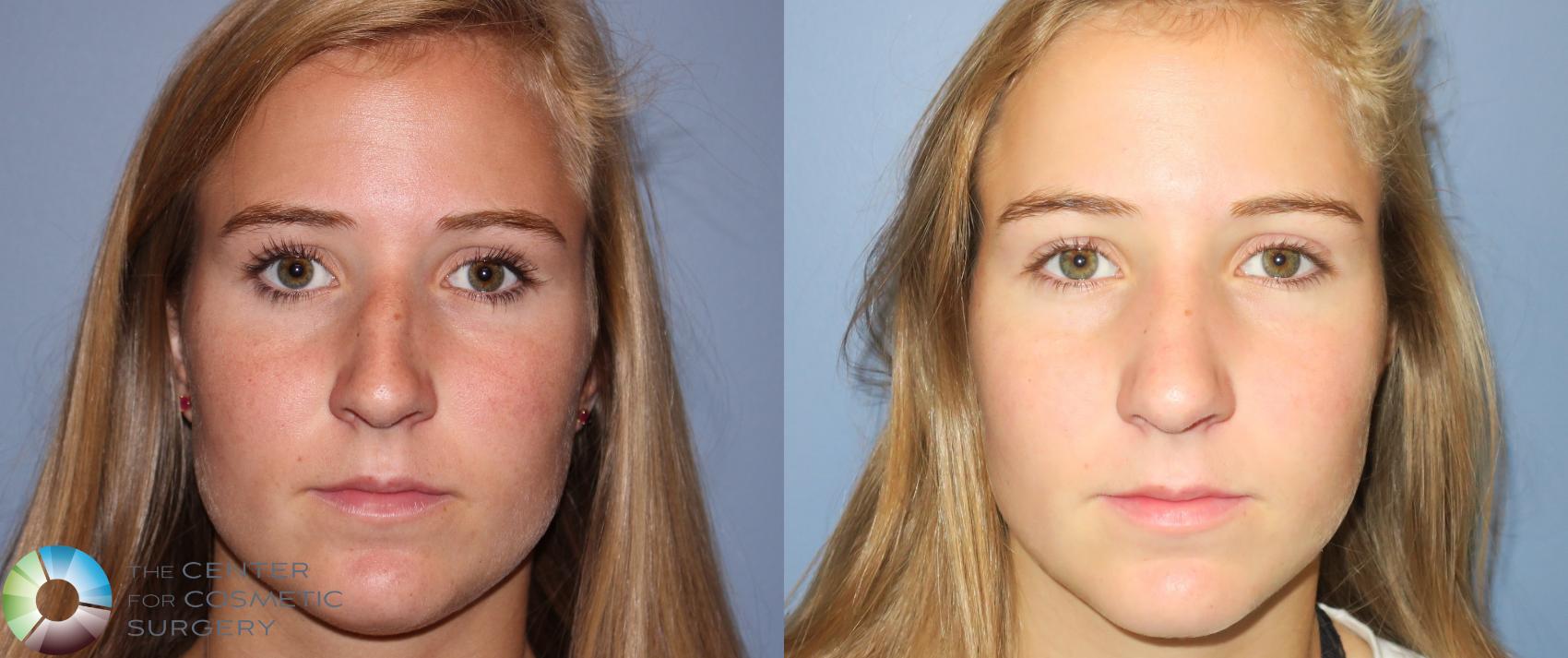Before & After Rhinoplasty Case 790 View #3 in Denver and Colorado Springs, CO