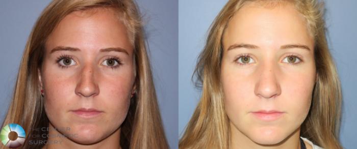 Before & After Rhinoplasty Case 790 View #3 View in Golden, CO