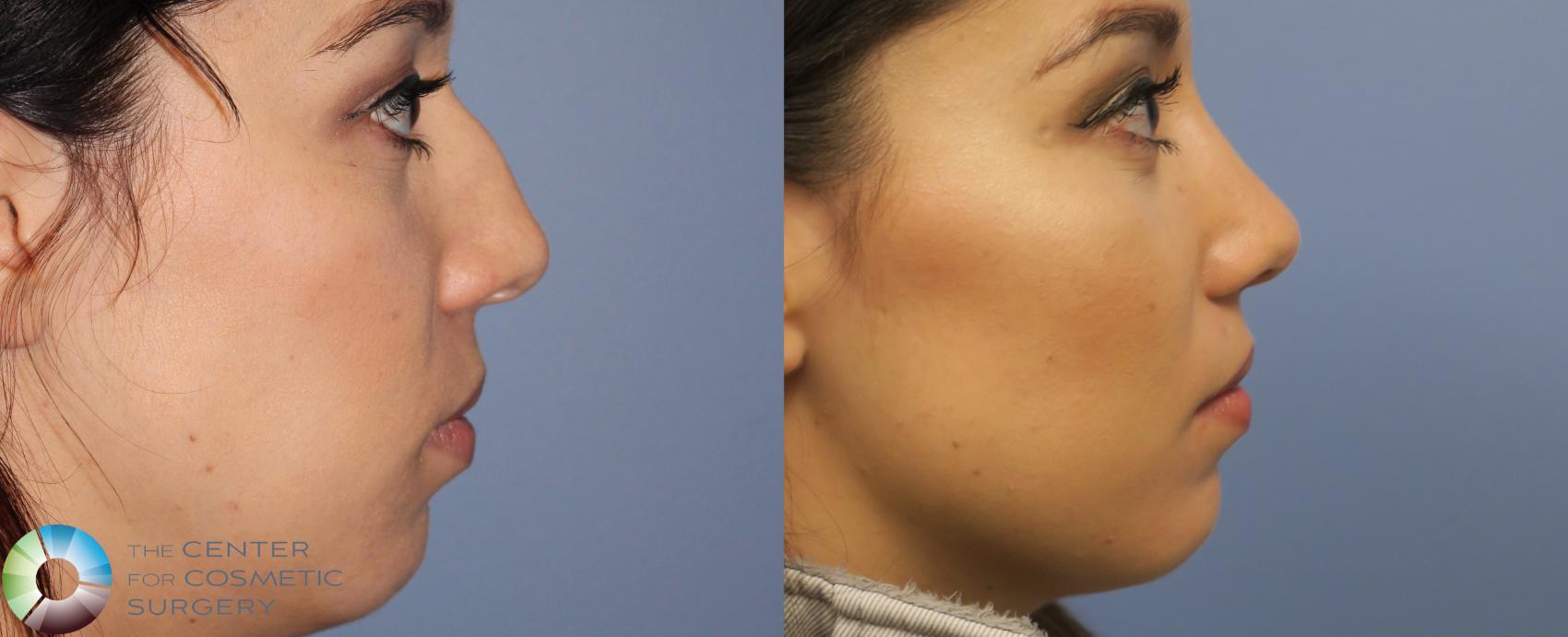 Before & After Rhinoplasty Case 815 View #1 in Denver and Colorado Springs, CO