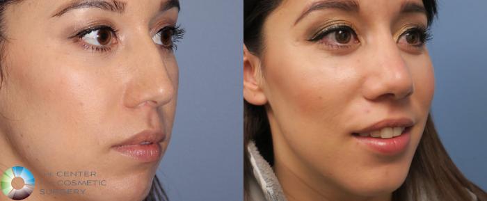 Before & After Rhinoplasty Case 815 View #2 in Denver and Colorado Springs, CO