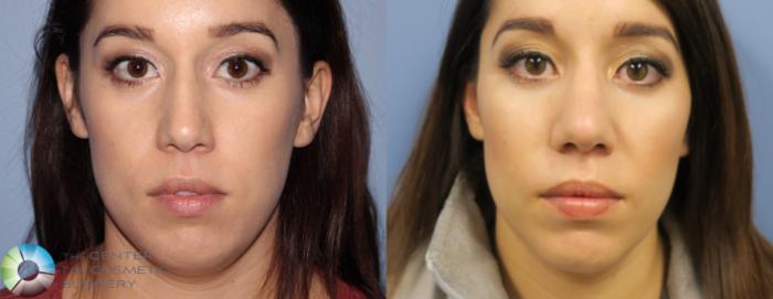 Before & After Rhinoplasty Case 815 View #3 in Denver and Colorado Springs, CO
