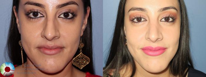 Before & After Rhinoplasty Case 816 Frontal View in Golden, CO