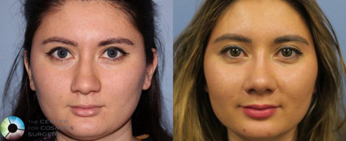Before & After Rhinoplasty Case 820 View #1 View in Golden, CO