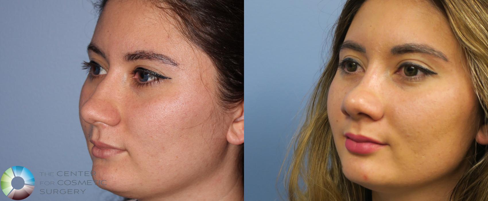 Before & After Rhinoplasty Case 820 View #2 in Denver and Colorado Springs, CO