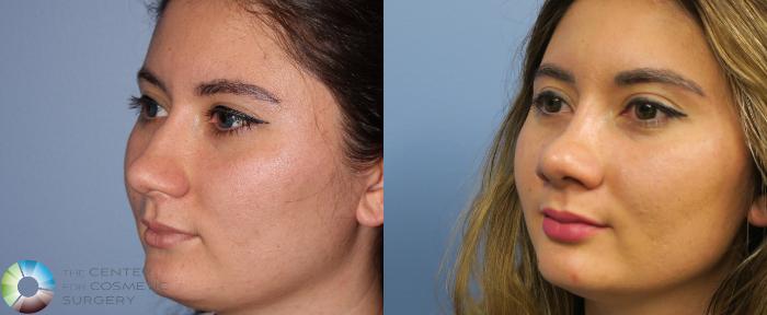 Before & After Rhinoplasty Case 820 View #2 View in Golden, CO