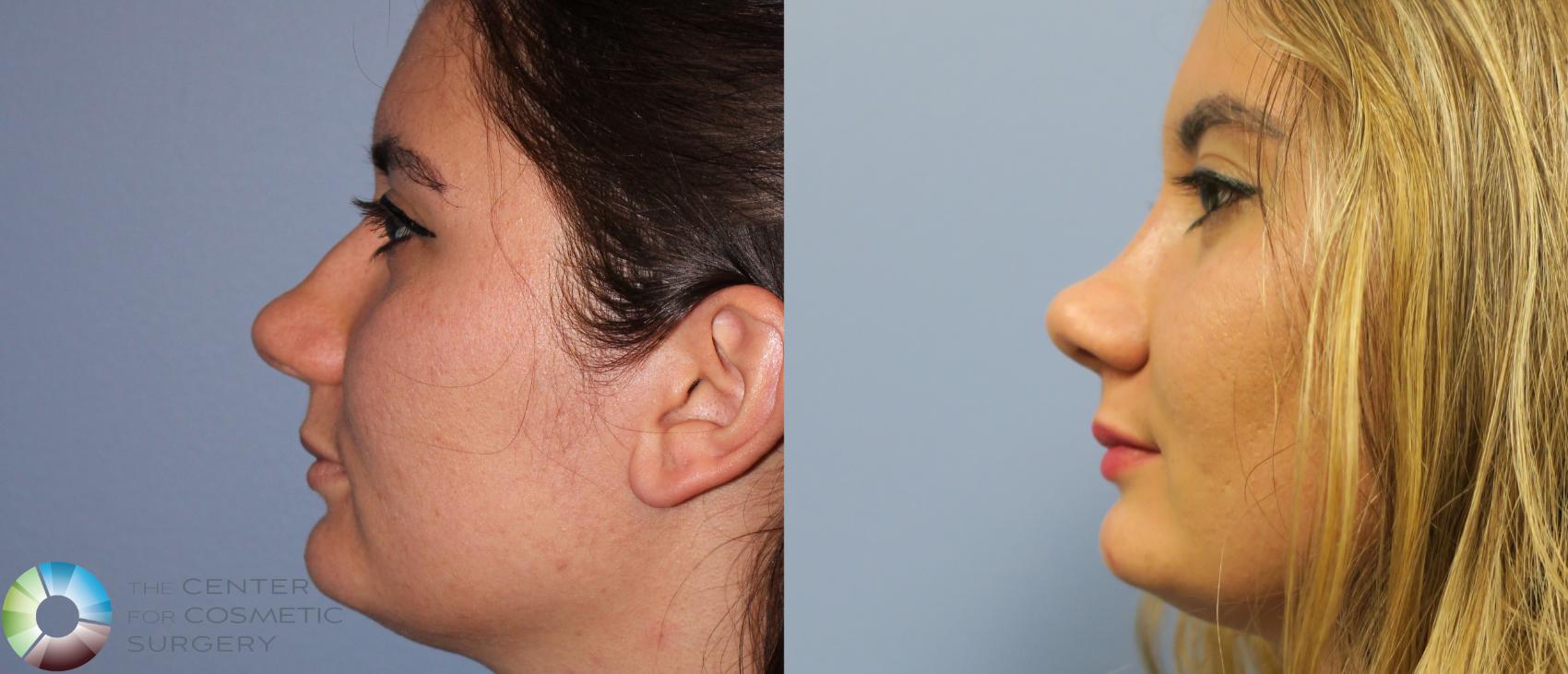 Before & After Rhinoplasty Case 820 View #3 in Denver and Colorado Springs, CO