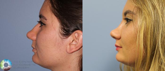 Before & After Rhinoplasty Case 820 View #3 View in Golden, CO