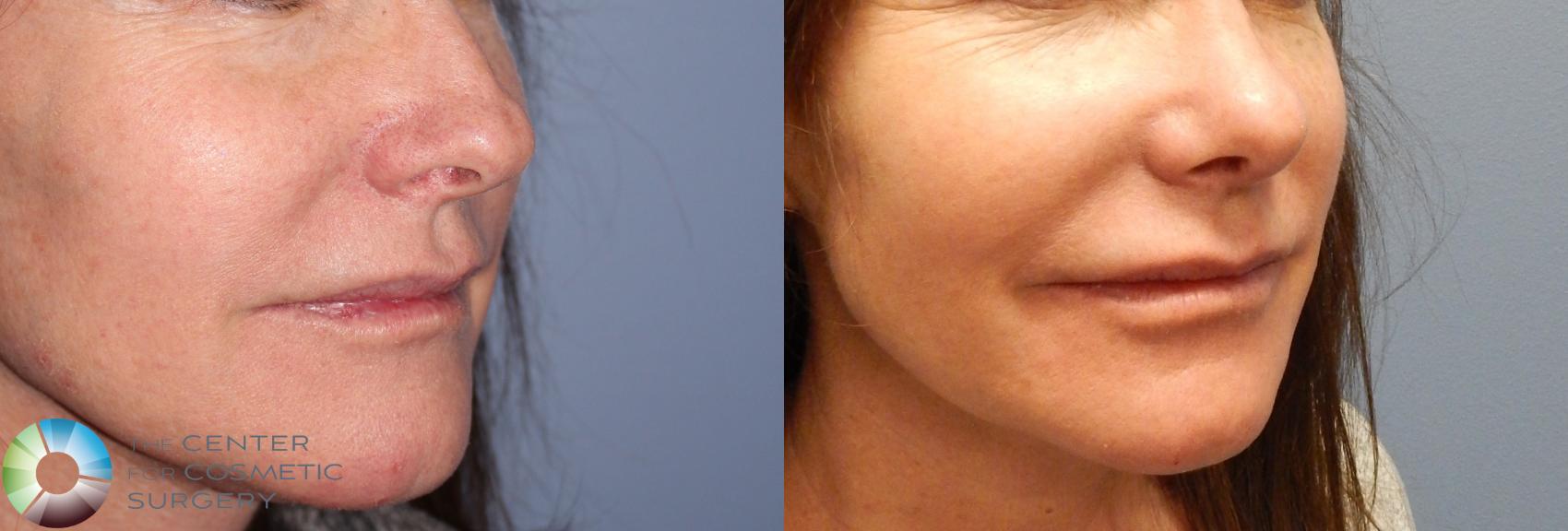 Before & After Rhinoplasty Case 840 View #1 in Denver and Colorado Springs, CO