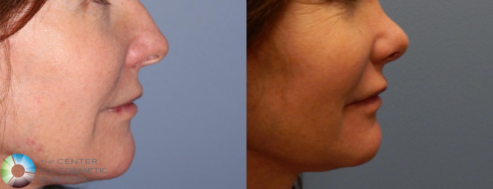 Before & After Rhinoplasty Case 840 View #2 in Denver and Colorado Springs, CO