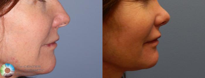 Before & After Rhinoplasty Case 840 View #2 in Denver and Colorado Springs, CO