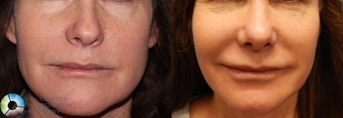 Before & After Rhinoplasty Case 840 View #3 in Denver and Colorado Springs, CO