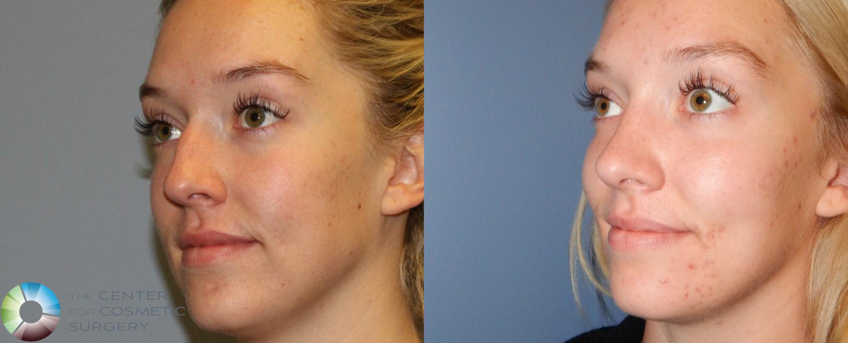Before & After Rhinoplasty Case 841 View #2 in Denver and Colorado Springs, CO
