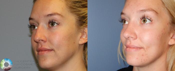 Before & After Rhinoplasty Case 841 View #2 View in Golden, CO