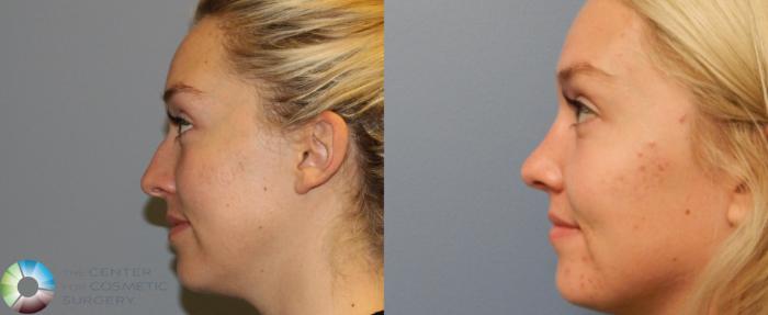Before & After Rhinoplasty Case 841 View #3 View in Golden, CO