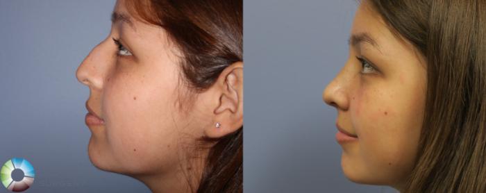 Before & After Rhinoplasty Case 842 View #1 in Denver and Colorado Springs, CO
