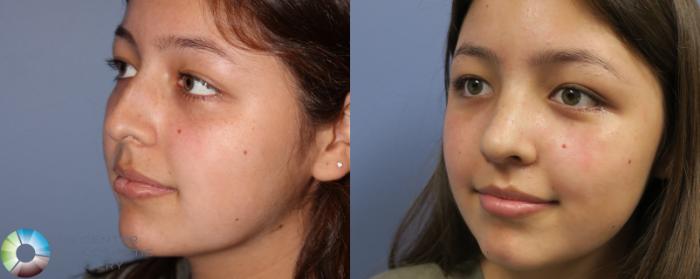 Before & After Rhinoplasty Case 842 View #2 in Denver and Colorado Springs, CO