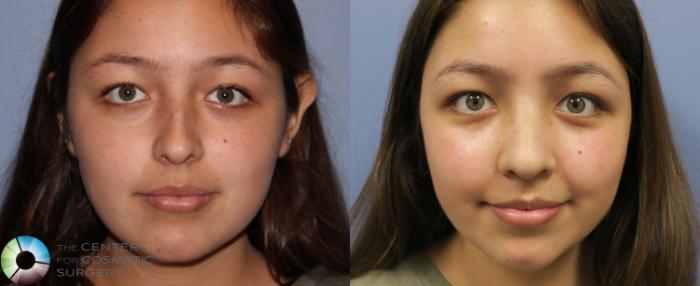 Before & After Rhinoplasty Case 842 View #3 in Denver and Colorado Springs, CO