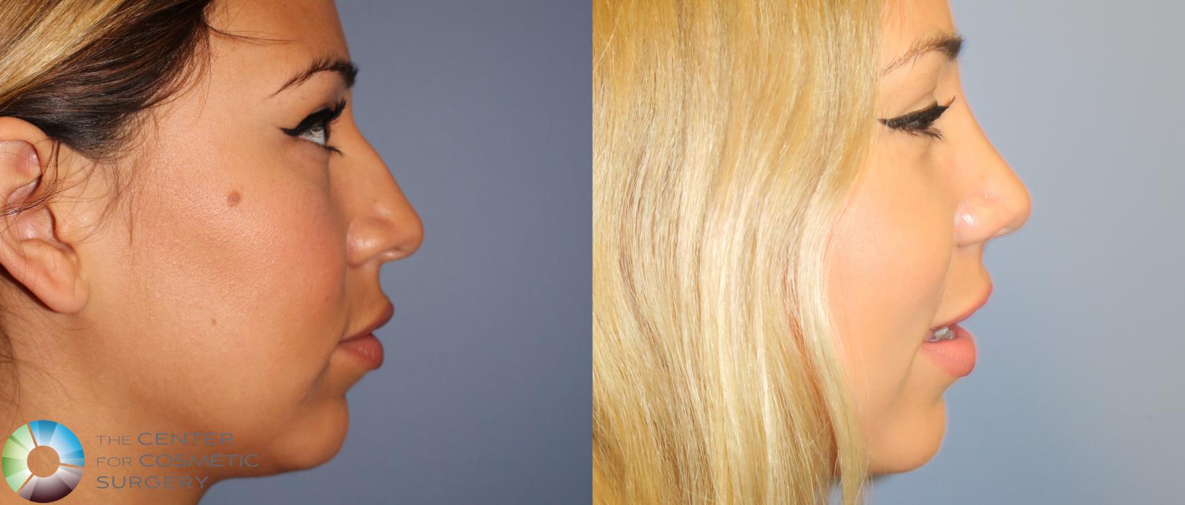 Before & After Rhinoplasty Case 862 View #1 in Denver and Colorado Springs, CO