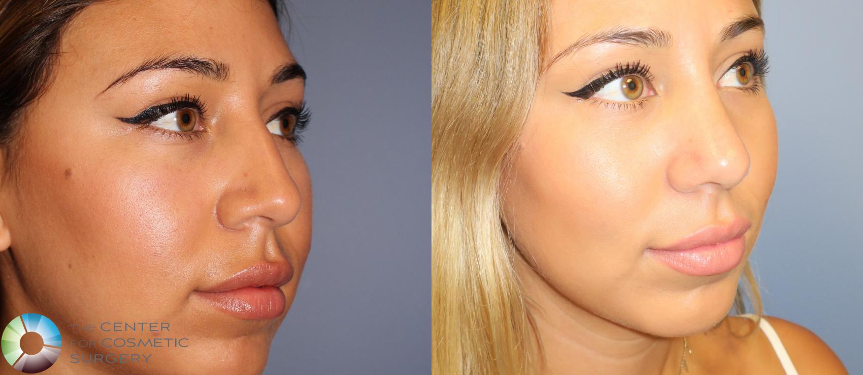 Before & After Rhinoplasty Case 862 View #2 in Denver and Colorado Springs, CO