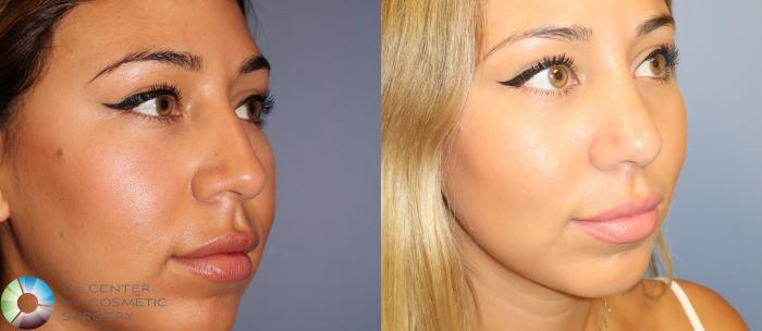 Before & After Rhinoplasty Case 862 View #2 in Denver and Colorado Springs, CO