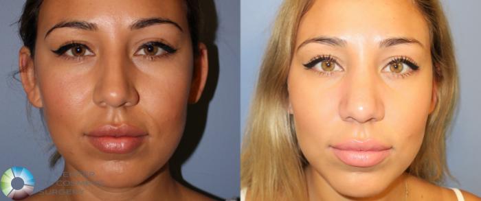 Before & After Rhinoplasty Case 862 View #3 in Denver and Colorado Springs, CO
