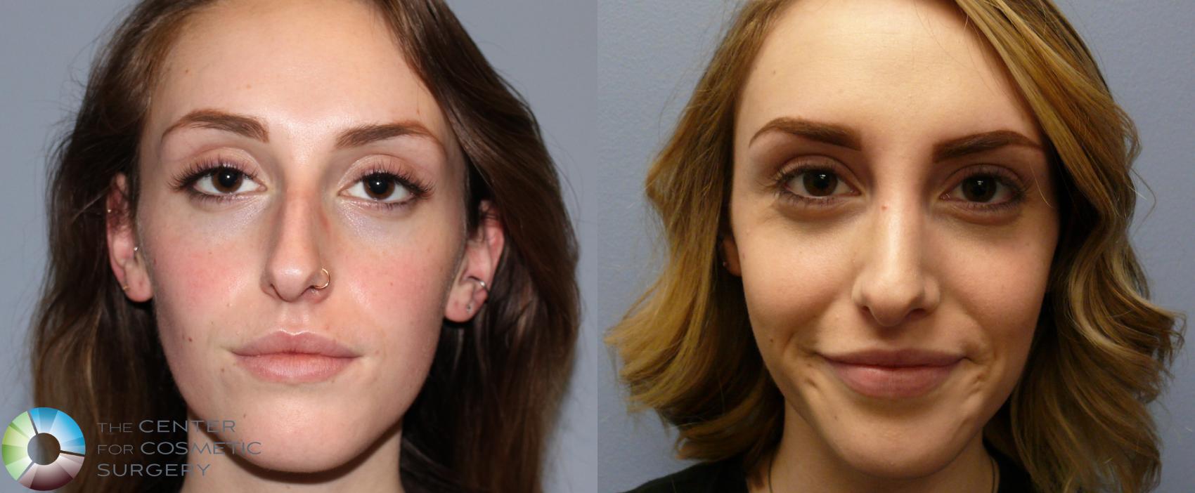 Before & After Rhinoplasty Case 897 View #1 in Denver, CO