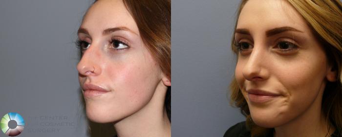 Before & After Rhinoplasty Case 897 View #2 View in Golden, CO