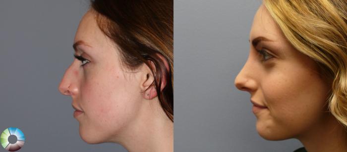 Before & After Rhinoplasty Case 897 View #3 View in Golden, CO