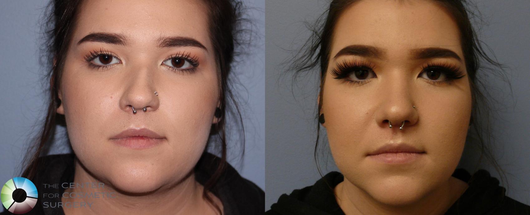 Before & After Rhinoplasty Case 899 View #1 View in Golden, CO