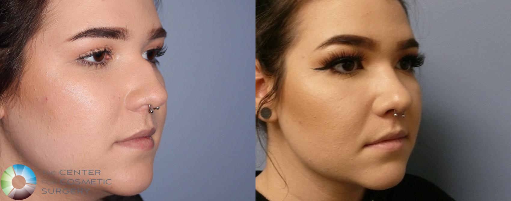 Before & After Rhinoplasty Case 899 View #2 View in Denver & Golden, CO